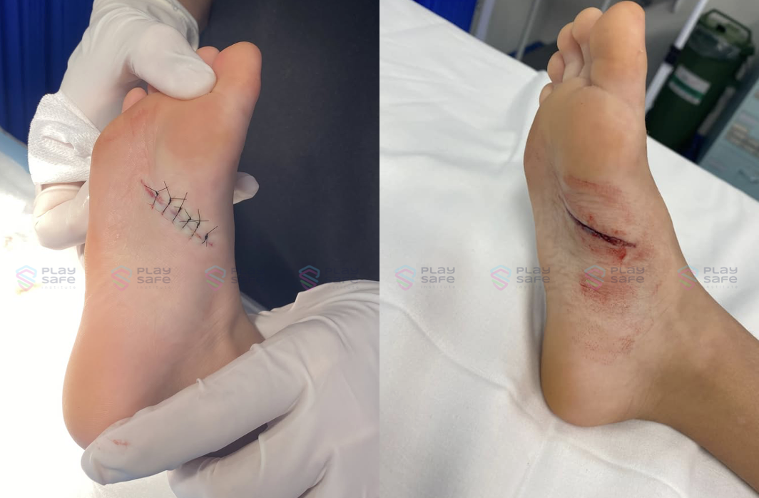 Playground Splash Area Closed After Child Suffers Foot Injury Image showing foot laceration wound and stitches approximately 5cm in length caused by contact with a sharp object in a playground water play area.